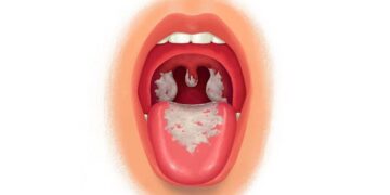 diphtheria outbreak