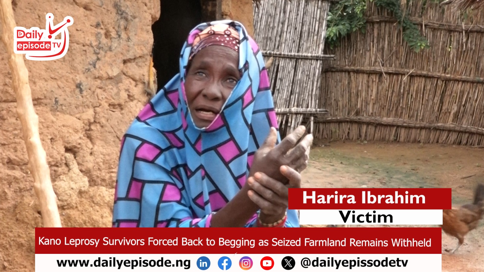 Leprosy Survivors